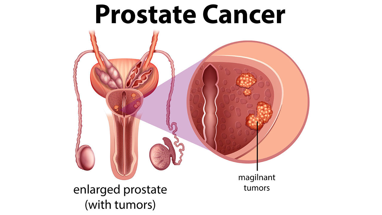 The Anatomy of Prostate Cancer