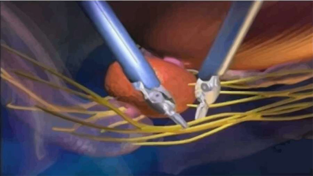 How to speed up nerve regeneration after prostate surgery