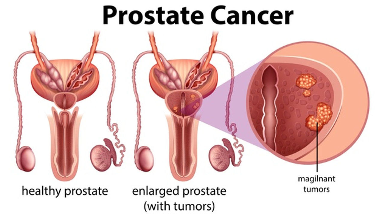 How Does Prostate Cancer Cause Death